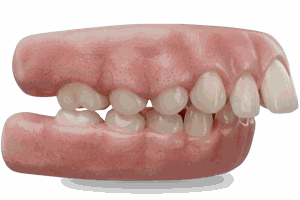 Teeth That Stick Out